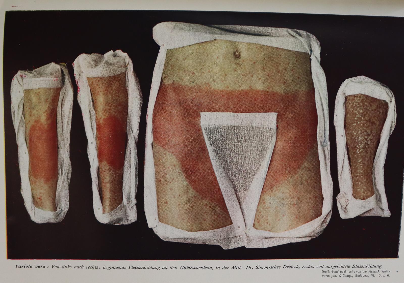 Beiträge zur Kriegsheilkunde. | Bild Nr.2