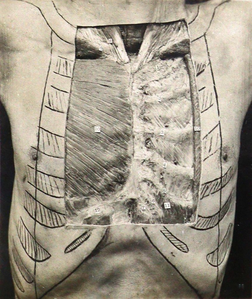 Große Abbildung Nr.1: 125-1509 Waterston,D. u. E.Burnet.: (Medizin, Anatomie)