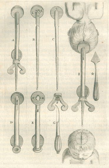 Große Abbildung Nr.1: 125-1557 Mauriceau,F.: (Medizin, Gynäkologie)