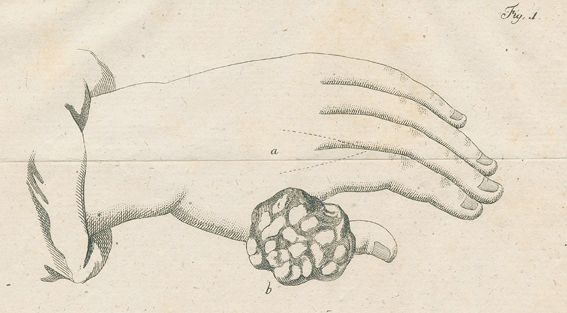 Große Abbildung Nr.2: 128-1827 Astruc,J.: (Medizin)