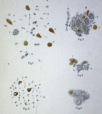 Bild Nr.1: 128-32 Hämatologie.: (Aus der Sammlung Professor Dr.Dr.Johannes Büttner Teil 1)