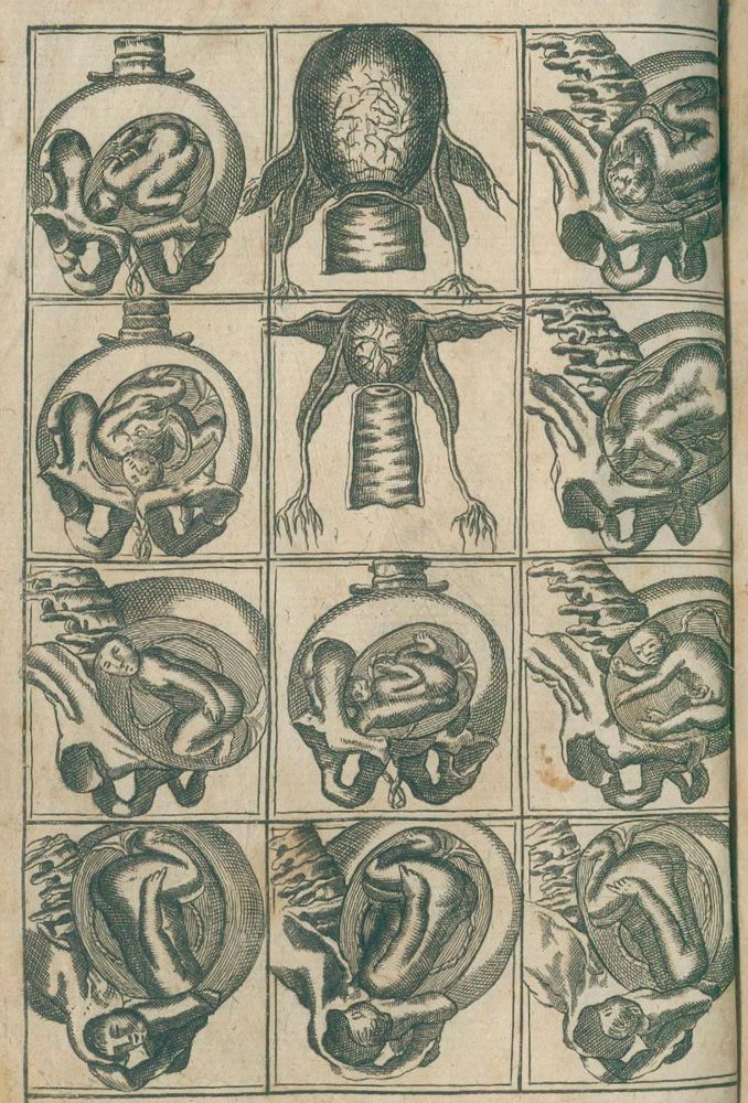 Große Abbildung Nr.1: 132-1362 Deventer,H.: (Medizin, Gynäkologie)
