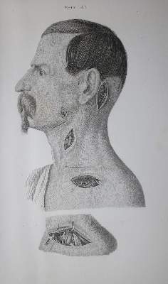 Bild Nr.1: 136-1455 Pitha,(F.)v. u. (C.A.)Billroth.: (Medizin, Chirurgie)