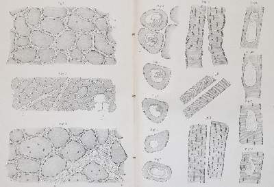 Bild Nr.1: 139-1581 Erb,W.: (Medizin, Thomsen'sche Krankheit)