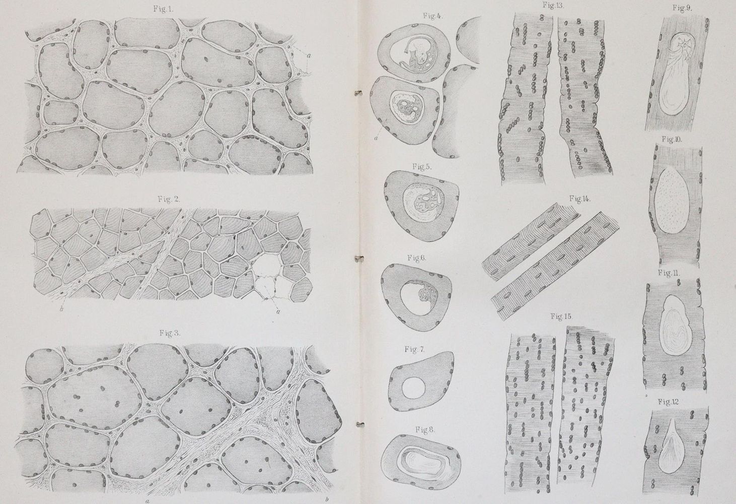 Große Abbildung Nr.11: 140-1872 Handschuch,G.F.: (Medizin, Syphilis)