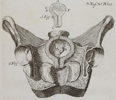 Große Abbildung Nr.3: 141-1674 Steidele,R.J.: (Medizin, Gynäkologie)