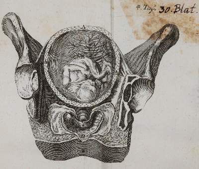 Große Abbildung Nr.4: 141-1674 Steidele,R.J.: (Medizin, Gynäkologie)