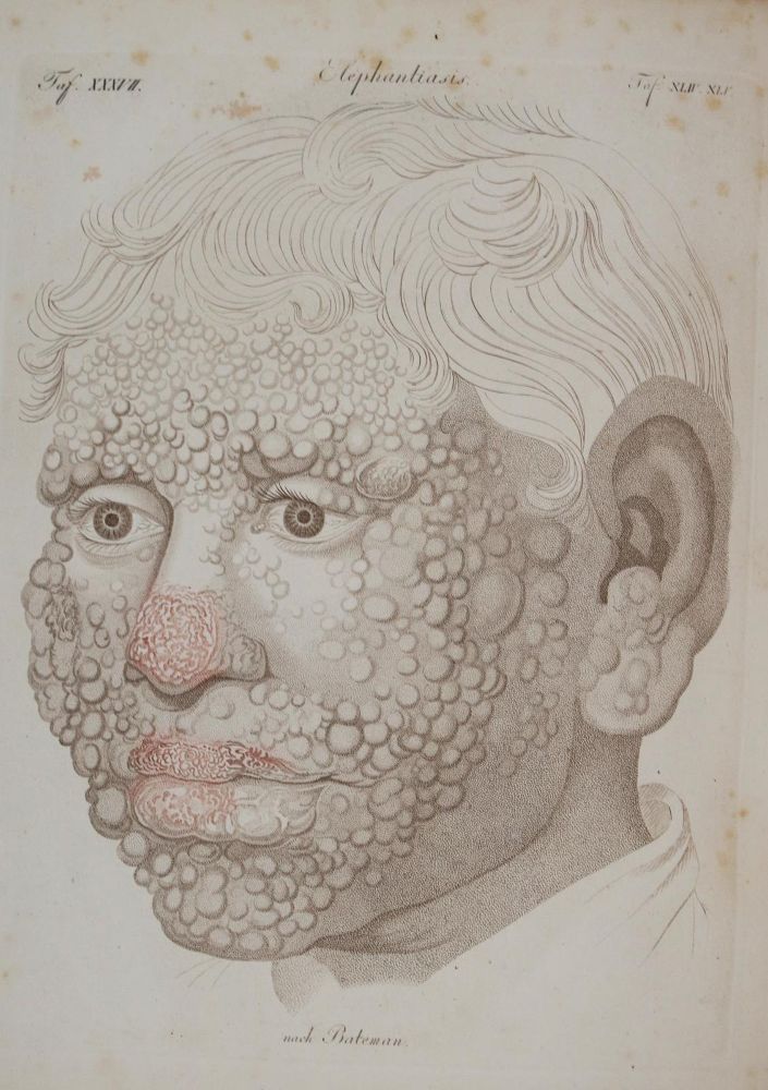 Große Abbildung Nr.2: 144-1342 Bateman,T.: (Medizin)