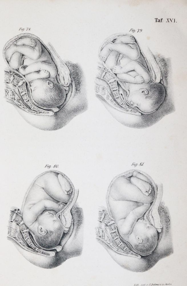 Große Abbildung Nr.3: 144-1370 Busch,D.W.H.: (Medizin, Gynäkologie)