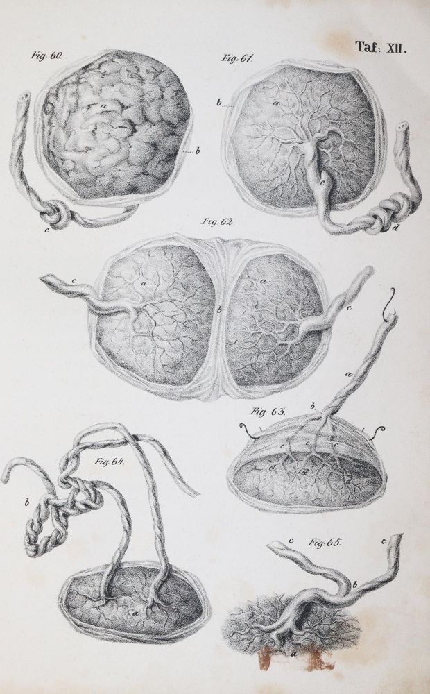 Große Abbildung Nr.4: 144-1370 Busch,D.W.H.: (Medizin, Gynäkologie)