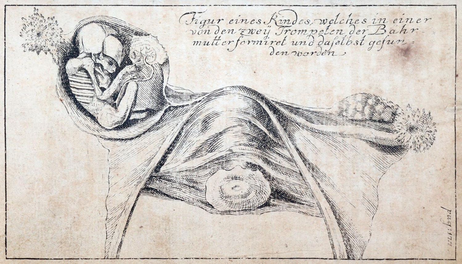 Große Abbildung Nr.4: 144-1371 Dionis,P.: (Medizin, Gynäkologie)