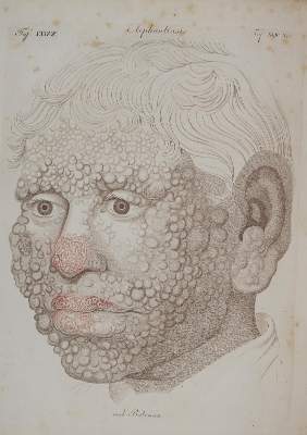 Bild Nr.2: 144-1342 Bateman,T.: (Medizin)