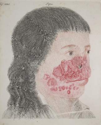 Bild Nr.3: 144-1342 Bateman,T.: (Medizin)