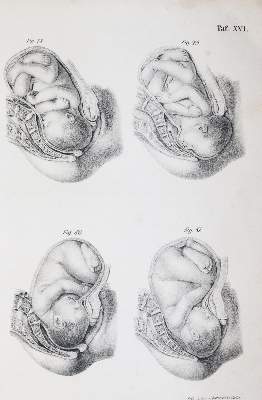 Bild Nr.3: 144-1370 Busch,D.W.H.: (Medizin, Gynäkologie)