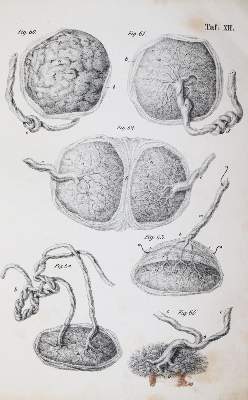 Bild Nr.4: 144-1370 Busch,D.W.H.: (Medizin, Gynäkologie)