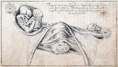 Bild Nr.4: 144-1371 Dionis,P.: (Medizin, Gynäkologie)